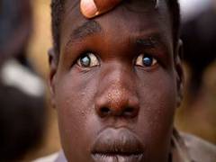 
      
      New diagnostic method for posterior uveitis eye disease
      
      