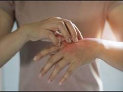 
      
      Scientists discover new drug to lower symptoms of severe eczema
      
      