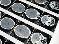 
      
      What happens in brain when it becomes too hot?
      
      