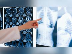 
      
      Hospitalization during COVID-19 damages lungs: Study
      
      
