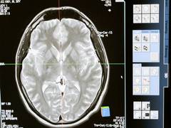
      
      Study explains why women are at greater risk for Alzheimer's
      
      