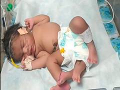 
      
      Girl born with 'four' legs in MP's Gwalior
      
      
