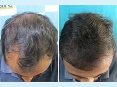 
      
      VCare's Hair Transplantation Ensures To Reverse Baldness
      
      
