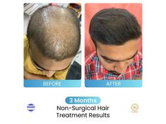 
      
      Dr Stuti Khare Shukla's Non-Surgical Hair Growth Booster
      
      