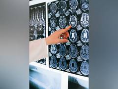 
      
       Head injury associated with doubled mortality rate in long term
      
      