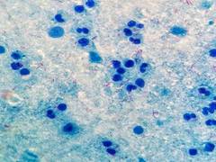 
      
      Marburg vaccine shows promising results in first-in-human study
      
      