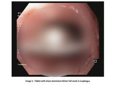 
      
      Delhi: 61-yr-old swallows pill with aluminium blister foil, saved
      
      