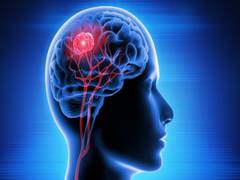 
      
      Risk of early death varies on different factors in epilepsy
      
      