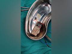 
      
      15-year-old girl swallows mobile, doctors take out successfully
      
      