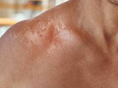 
      
      Skin injuries spike during heat waves in India 
      
      