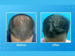 
      
      VCare's treatment for hair loss and hair thinning
      
      
