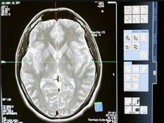
      
      Anosognosia is connected with brain network connections: Study
      
      
