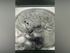 
      
      Jaipur's Eternal Hospital rare feat in Neurointervention
      
      