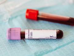 
      
      Lewy body disease can be detected before symptoms appear: Study
      
      
