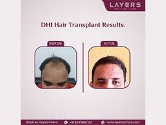 
      
      Layers Implements Direct Hair Implantation
      
      