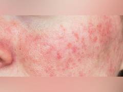 
      
      Psoriasis cases on the rise in India, doctors warn
      
      
