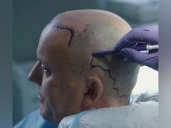 
      
      Top 20 Best Hair Transplants in Turkey 
      
      