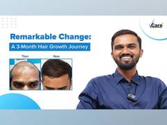 
      
      Unlock Your Confidence with VCare's Revolutionary Hair Regrowth 
      
      