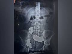 
      
      Delhi: Doctors recover coins, magnets from patient's intestines 
      
      