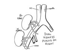 
      
      AIIMS Delhi performs first dual kidney transplant in 51-year-old
      
      