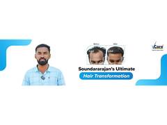 
      
      Reversing baldness with VCare
      
      
