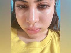 
      
      Uorfi Javed shares pics of swollen face
      
      
