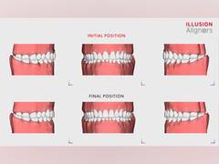 
      
      Illusion Aligners Takes the World of Orthodontics by Storm
      
      