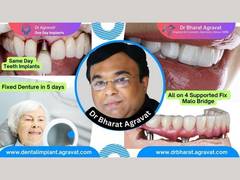 
      
      Best Dentist for Full Mouth Dental Implants Clinic in Ahmedabad
      
      