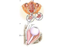 
      
      Untreated sinusitis can lead to fungal infections
      
      