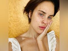 
      
      Tallulah opens up about her struggles with skin-picking disorder
      
      