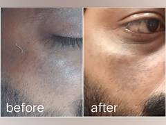 
      
      Over 80 per cent of Indian Women Affected by Melasma and PIH
      
      