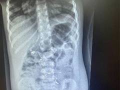 
      
      Two-year-old swallows mercury, saved due to early diagnosis
      
      