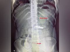 
      
      Doctors in Delhi hospital remove shaving razor from man's stomach
      
      