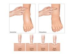 
      
      What is the most common cause of fluid retention 
      
      