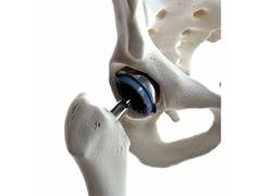 
      
      Hip Replacement Recovery: Q&A with a Hip Specialist
      
      