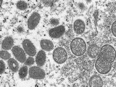 
      
      Khyber Pakhtunkhwa reports 8th mpox case of 2025
      
      