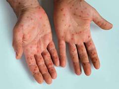 
      
      US records over 800 confirmed cases of measles this year
      
      