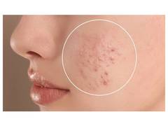 
      
      How to Treat Acne and Pigmentation?
      
      