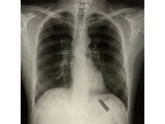 
      
      Plastic pen cap lodged in patient's lungs removed after 26 years
      
      