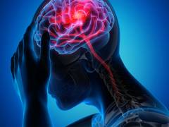 
      
      Experts raise concern over brain strokes among young adults
      
      