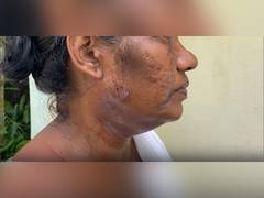 
      
      Kerala: BLO suffers neck, face injuries after dog released on her
      
      