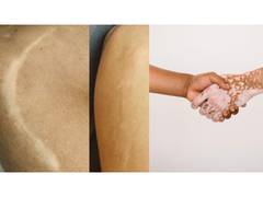 
      
      Scar and Vitiligo Treatment in Mumbai
      
      