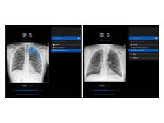 
      
      Manipal Hospitals Adopts Harrison.ai's chest X-ray AI
      
      