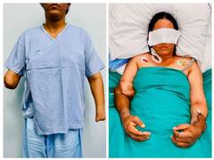 
      
      Hand Transplant gives new life to young mother
      
      