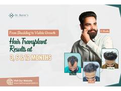 
      
      Hair Transplant Results at 3, 6 and 12 Months
      
      