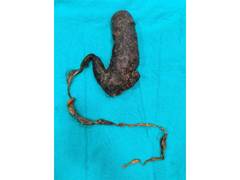 
      
      Doctors remove giant hairball from 30-year-old woman
      
      