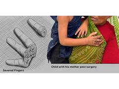 
      
      Zydus Hospital Surgeons Reattach Toddler's Severed Fingers 
      
      