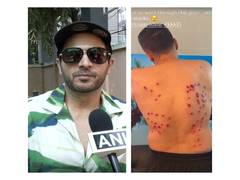 
      
      Khatron Ke Khiladi: Gaurav Khanna suffers severe laser burns
      
      