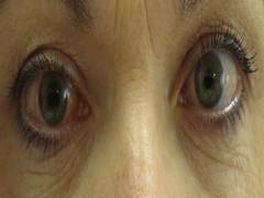 
      
      Genetic test developed to predict onset of glaucoma 
      
      