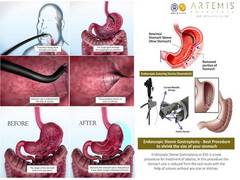 
      
      Artemis Hospital performs North India's first Endoscopic...
      
      